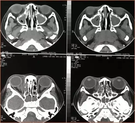 急性鼻窦炎并发症脓肿骨壁破坏ct:鼻窦密度增高water氏位:窦腔混浊,液