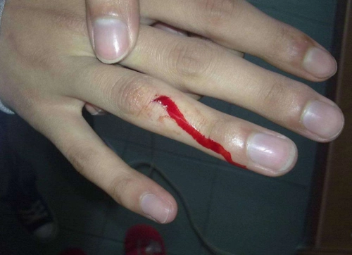 手出血的图片61