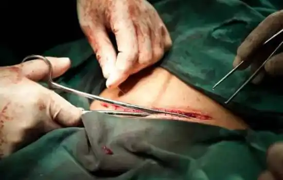 100张剖腹产实拍图,女人真的太伟大了!