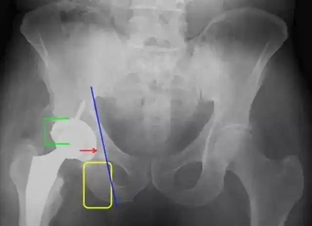 aaos2017髋臼骨缺损paprosky分型及处理方法