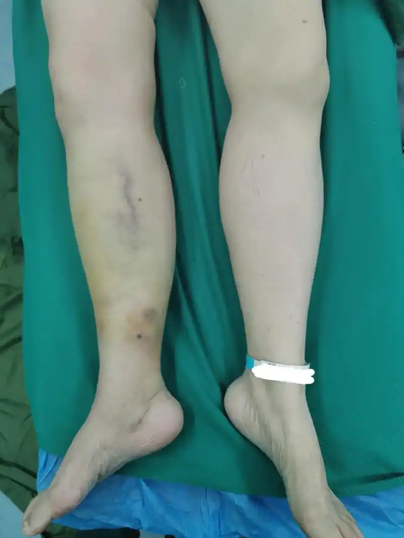 如果小腿骨折骨头外露了需要在保证不