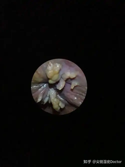 尖锐湿疣肛周疣体症状图片