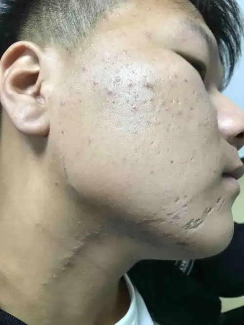 不一样的黑头粉刺