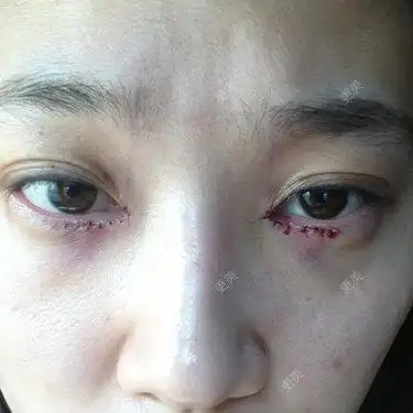 为什么我开眼角都恢复一两年的时间了内眼角还留有白色的疤痕