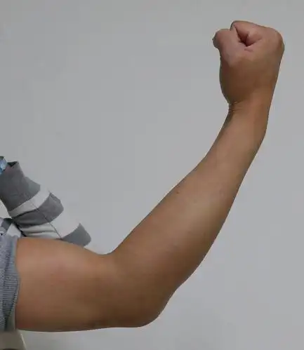 术前肘关节伸直20度