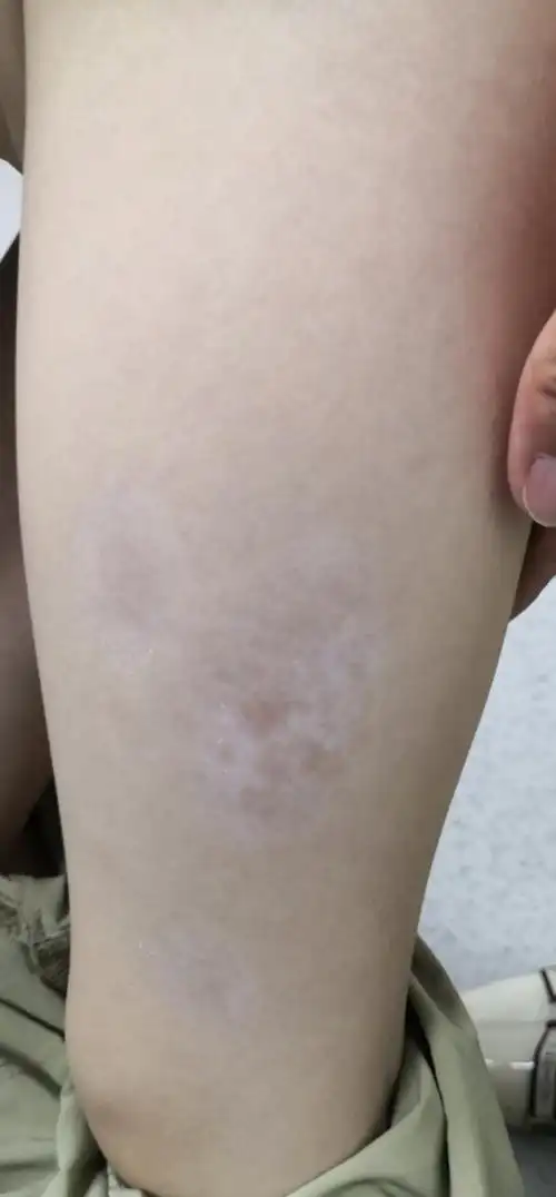 白癜风##解决皮肤问题专注皮肤美容