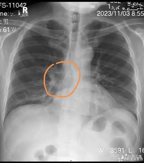 每周胸片203无症状正侧位胸片练练眼力