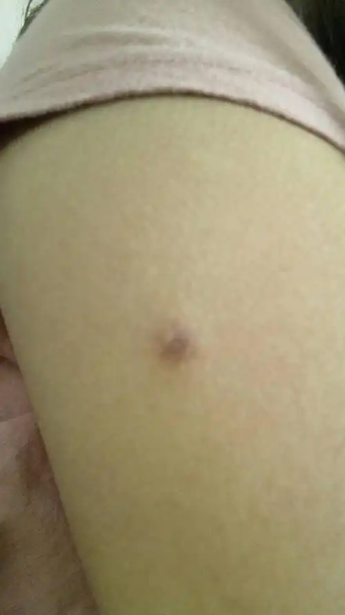 手臂上长了一颗痘痘大小的肿块.不痛不痒,紫黑色.大概两年了.偏硬.