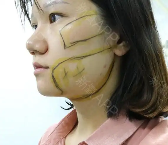 【光纤溶脂瘦脸案例】肉肉脸女孩的精致变形记!