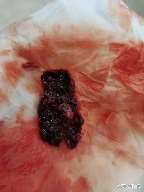 药流历时43天,坚持不清宫,最终排出30mm大残留(带图),分享给迷茫的