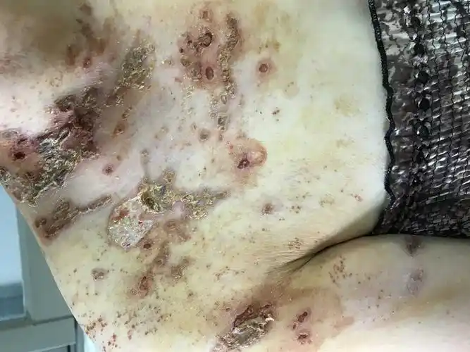 蛇串疮病是什么病