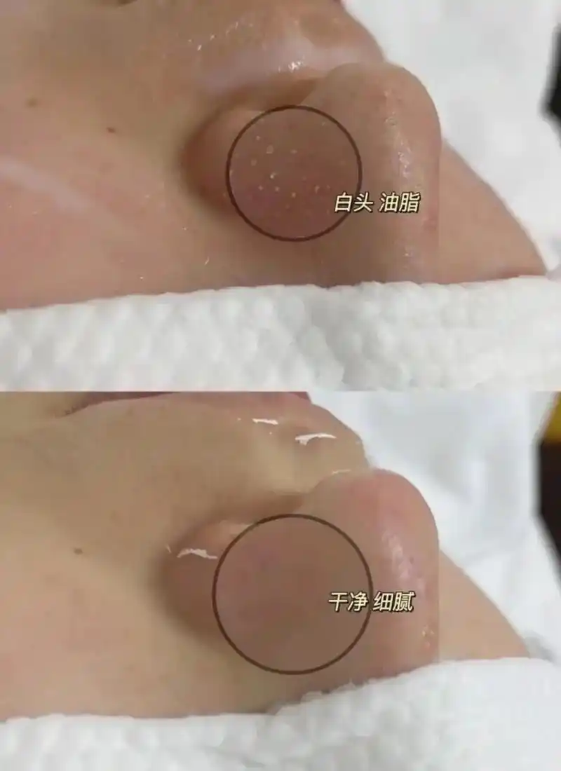 大气泡毛孔深层清洁 专治各种黑头 粉刺 毛孔粗大 痘痘肌  - 兑音