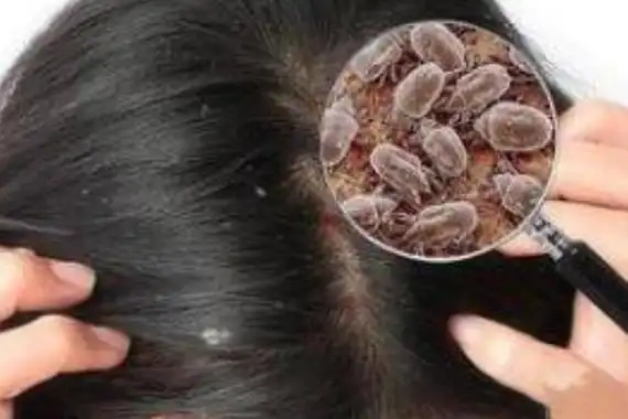 剪发虫是一种喜欢吃皮脂的寄生虫,因此在人类的头皮上,它们会长期的