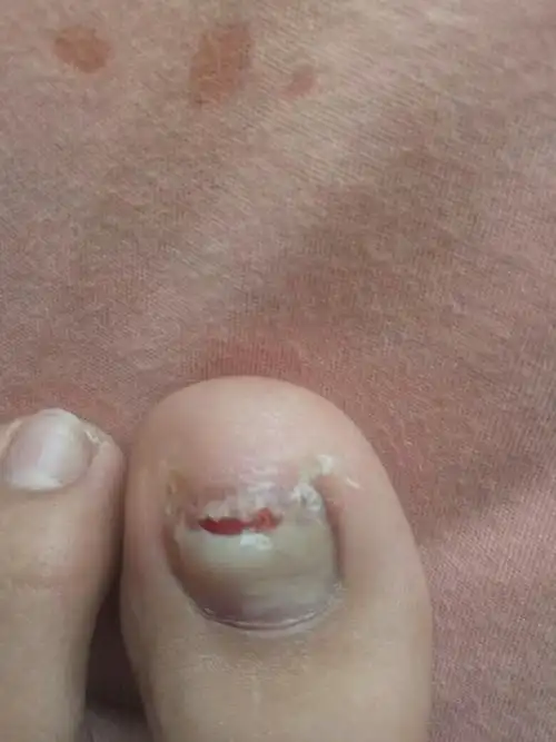 本来脚穿小鞋疼,然后今天一看大母脚趾头盖发白
