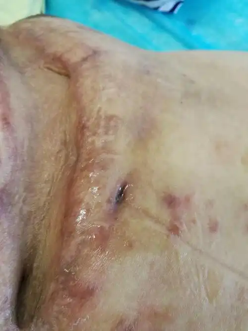 2,右侧胸腔感染并胸腔积液,3,右背部蜂窝组织炎