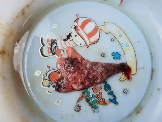 推荐回答 脱落的内膜和绒毛.