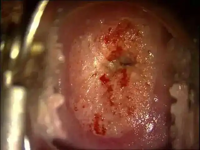 多图看懂阴道镜