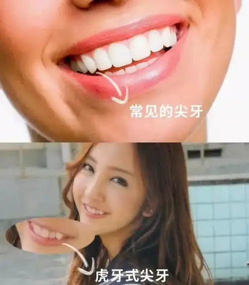 虎牙也叫犬齿,主要是因为尖牙的位置不足而引起的.