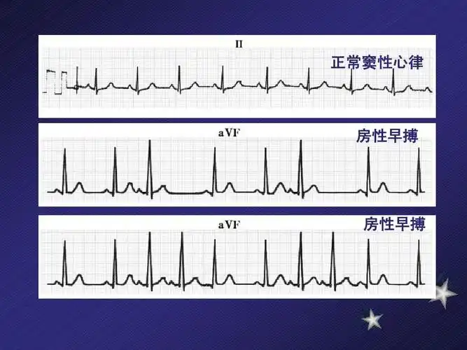正常窦性心律 房性早搏 房性早搏