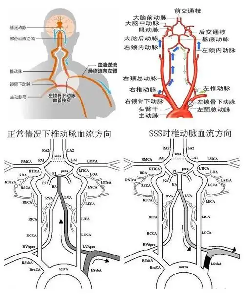 首页 科室导航 外科部 血管外科 科室动态  秀奶奶左侧锁骨下动脉窃血