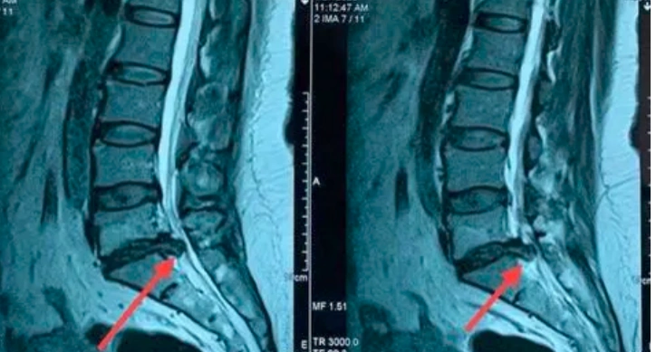 什么是椎间盘突出,脱出,膨出_腰椎间盘突出_腰椎间盘突出介绍 - 好