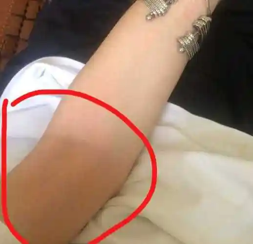 手臂上长痣代表什么手肘的外侧,代表是富贵之人