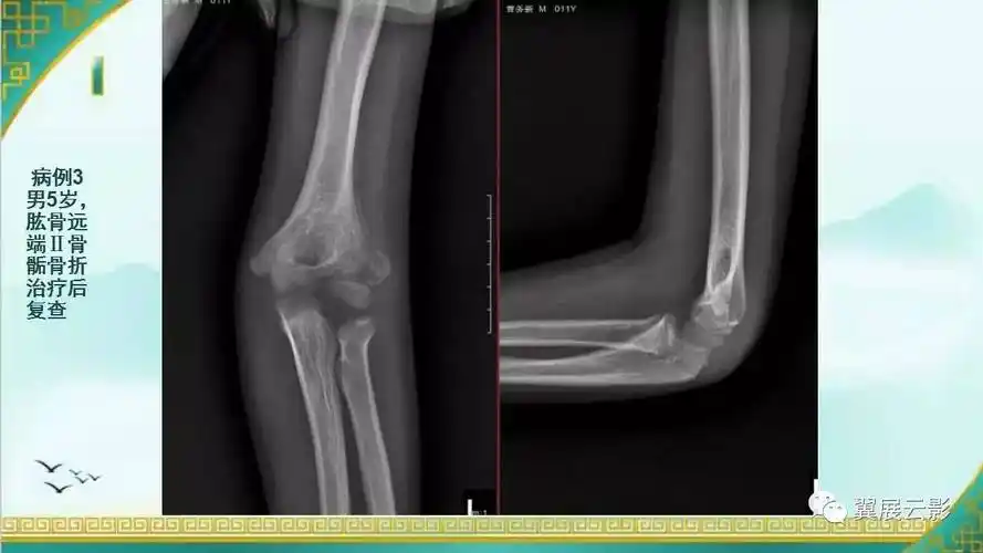 儿童肘关节损伤脂肪垫征