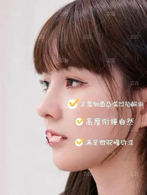 还有点歪,同时伴有鼻基底凹陷和面中凹陷的问题导致她看小巧鼻子小巧