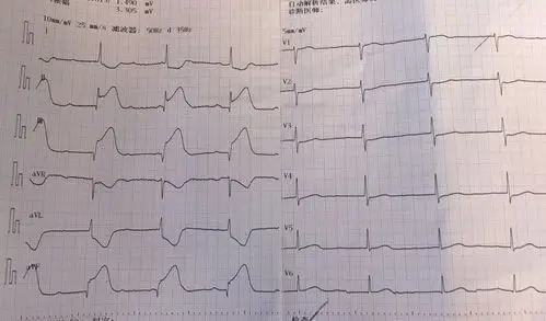 另一个是急性下后壁心肌梗死的心电图.