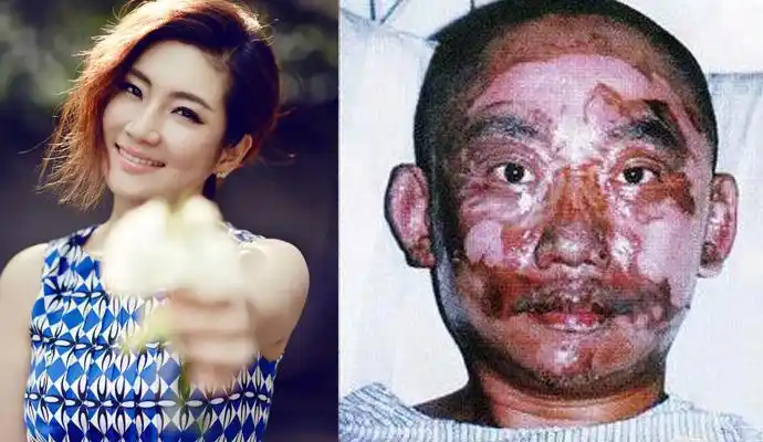 任家萱烧伤图片容颜尽毁全身大面积疤痕还惨遭老公扫地出门