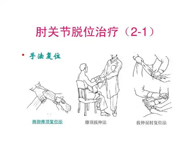 肘关节脱位治疗(2-1)   手法复位 拇指推顶复位法 膝顶拔伸法 拔伸屈