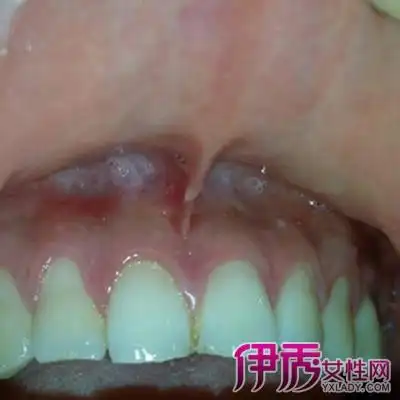 【图】上唇系带肿是怎么回事 揭秘口腔溃疡6个临床表现