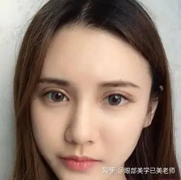 深邃有神的欧式大双为什么有的人整出来很丑