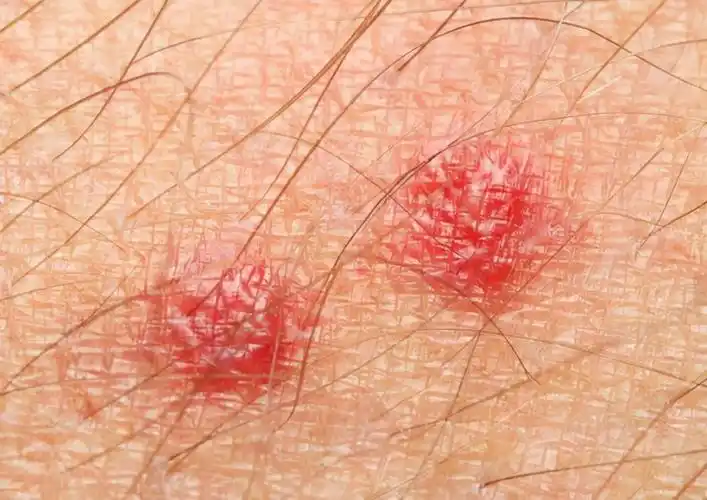 私处长痘痘一定是疣吗别慌还可能是这两种情况