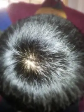 这头顶的头旋正常吗?是不是秃顶啊,感觉头发很少啊