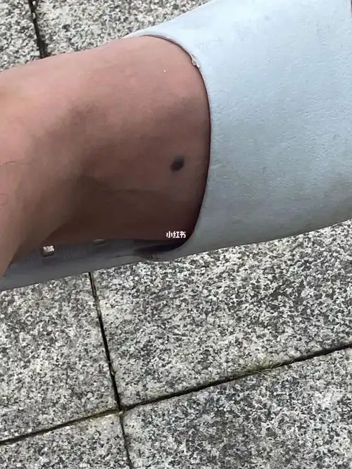 脚背长痣需要切掉嘛