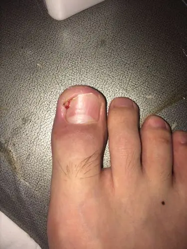 甲沟炎现在严重了.长小肉芽了?该怎么办?