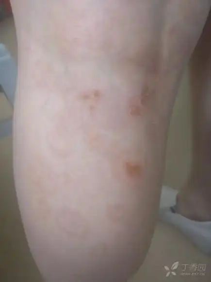 钱币样湿疹? [病例帖]