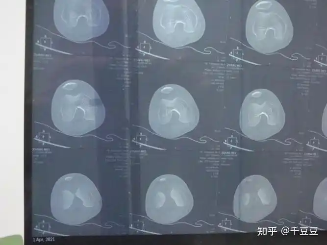 胫骨平台塌陷ct图片