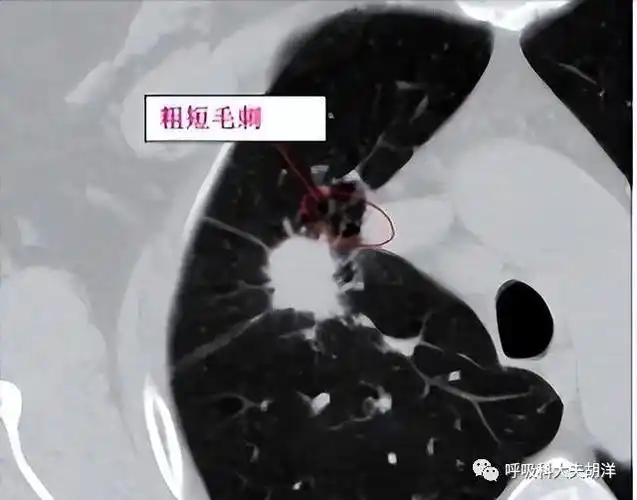 有毛刺的肺结节恶性的可能性比较大,但这并非绝对正确