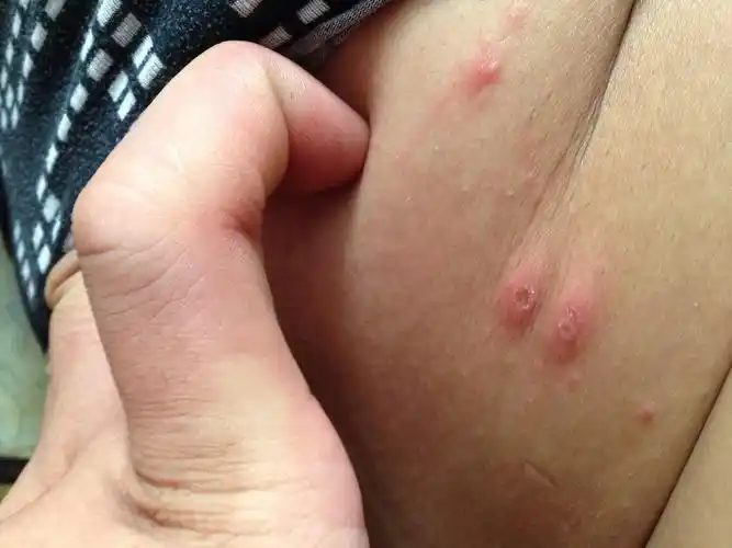 昨天张的几个水泡.在腰下面点.是什么啊?疱疹吗?