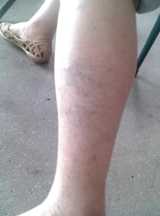 网状青斑 (35)_有来医生