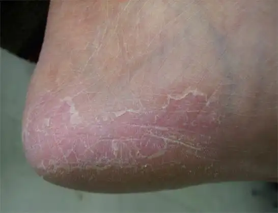 角化型手足癣图片角化型手足癣症状