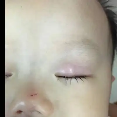 请问,宝宝眼皮长了一个东西,不知道是什麼东西