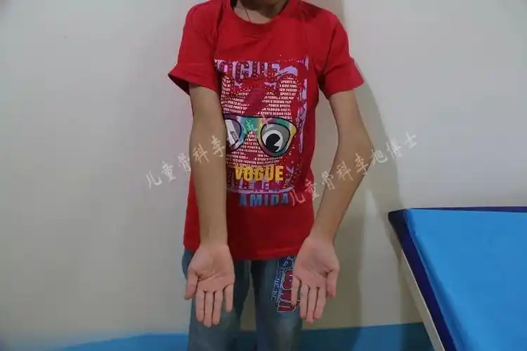 每日病例分享x2 | 左肘内翻畸形