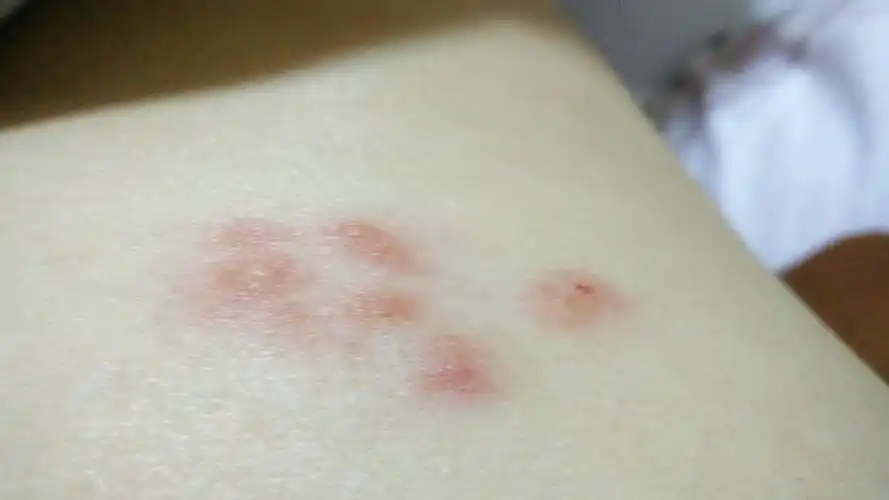 乳房边上突然长了一些这个东西,一开始是因为一样抓出来的,可是现在