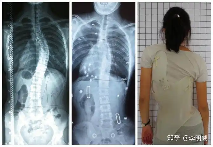 手术40度以上的手术功能性脊柱侧凸:30度以下的支具,训练结构性脊柱侧