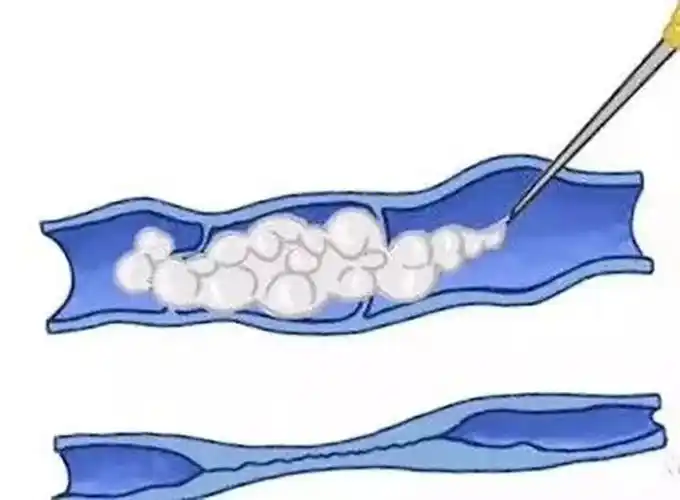 下肢静脉曲张治疗新选择环形激光泡沫硬化剂治疗