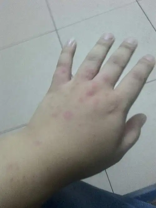 前几天不知道怎么回事,手上起了东西.昨天去医院说是螨虫.