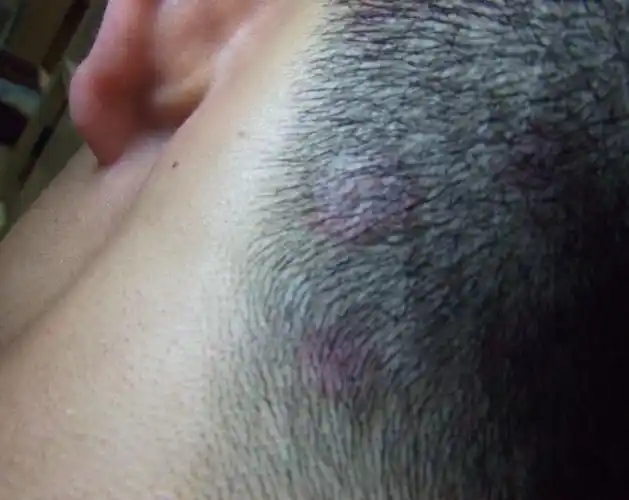 我这个是 头皮癣么 特别流汗的时候痒痒